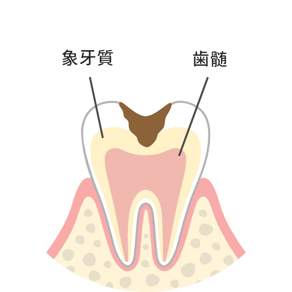 歯の中（象牙質）まで進んだ虫歯
