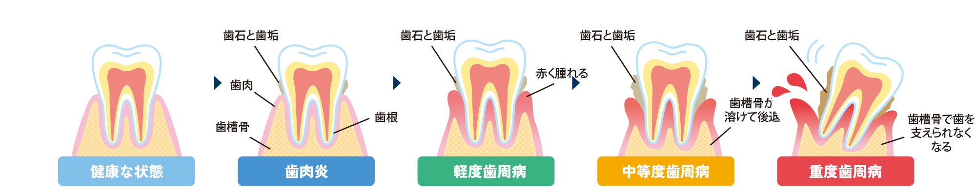 歯周病の進行