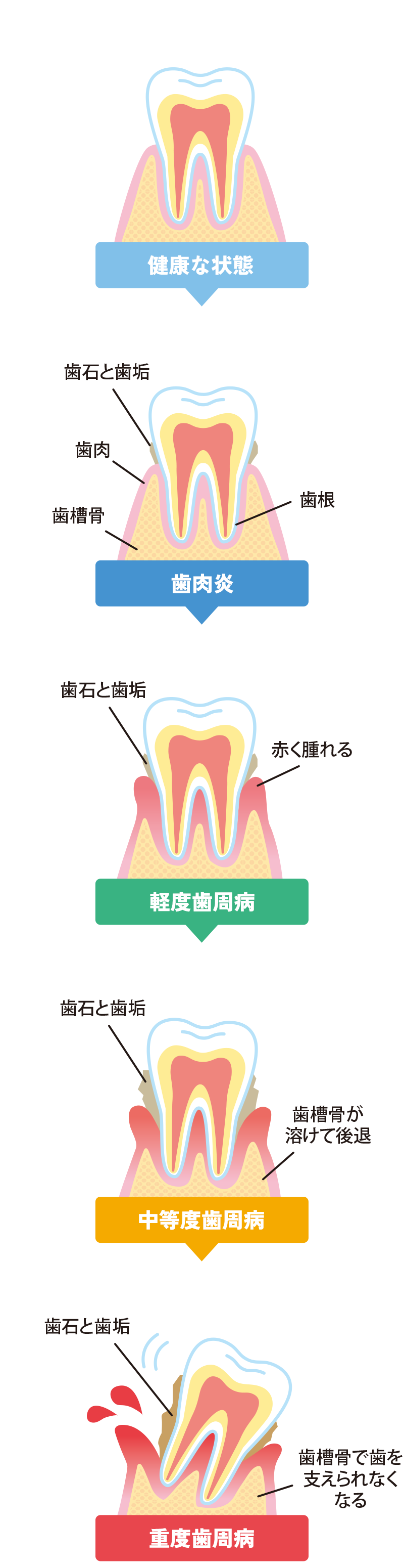 歯周病の進行
